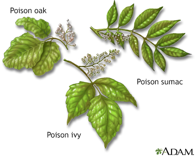 mild poison ivy rashes. The rash is spread by the oils